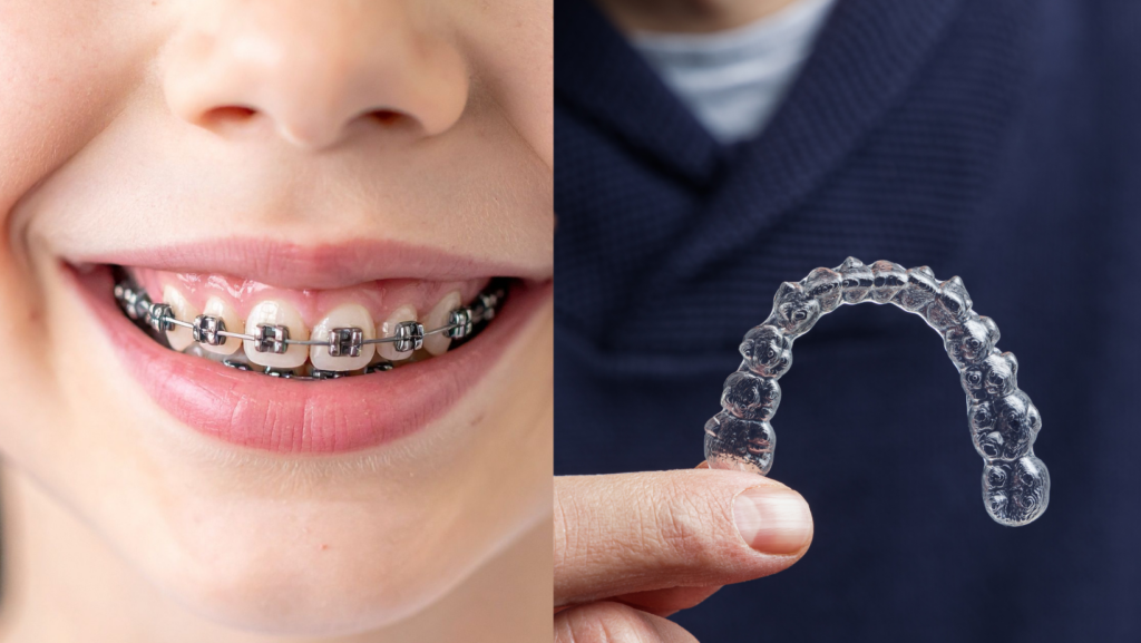 Child with braces and a clear aligner for adults